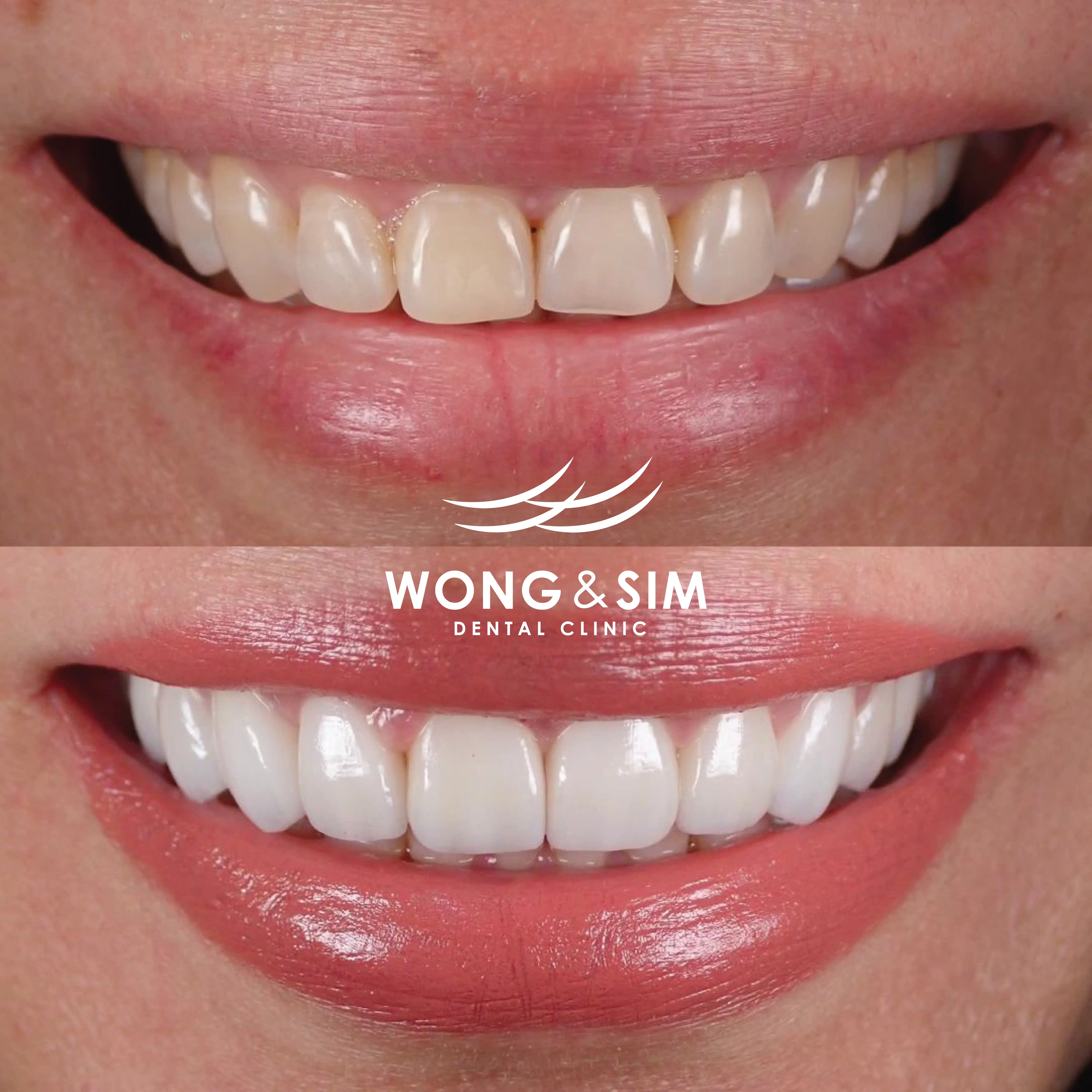 Patient 2 - Veneers Before and After